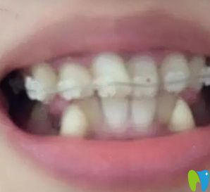 在順德壹加壹口腔戴陶瓷托槽牙套照