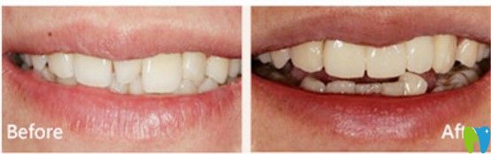 杭州美奧口腔3DS瓷貼面修復(fù)案例