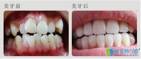 福州維樂(lè)口腔牙齒擁擠矯正圖