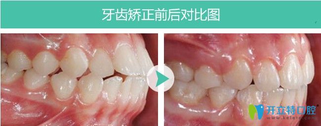 福州維樂(lè)口腔齙牙矯正圖