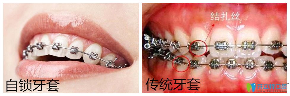 自鎖托槽牙齒矯正多少錢？正畸國產(chǎn)與進(jìn)口自鎖有區(qū)別嗎?