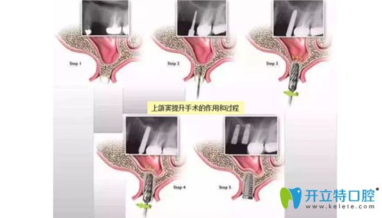 上頜竇外提升和內(nèi)提升的區(qū)別