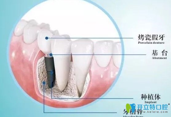 維樂(lè)口腔種植牙是由基臺(tái)、種植體組成圖示