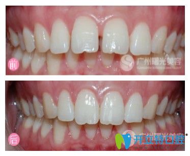 廣州曙光口腔前牙前突矯正案例