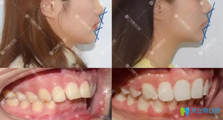 廣州曙光醫(yī)院員工矯正牙齒案例