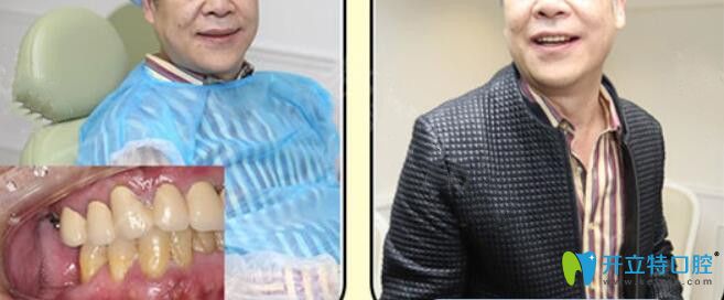 二級演員蘇先生在廣州柏德口腔種植牙案例
