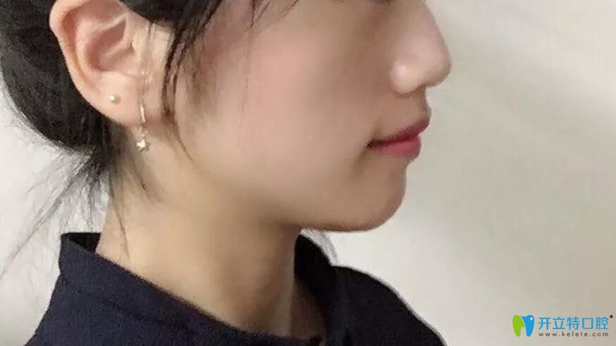 鼎植口腔快要摘牙套前側(cè)面圖 鼎植口腔快要摘牙套前側(cè)面圖