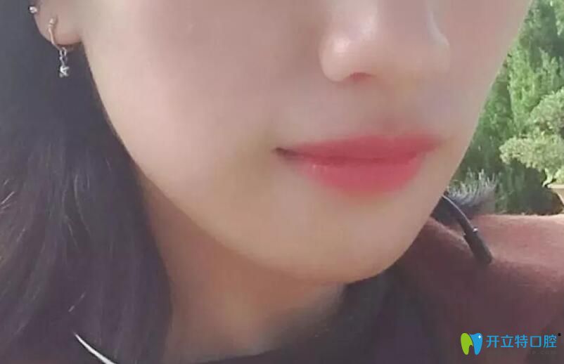 戴牙套過程掛橡皮筋收縫階段正面臉型圖 戴牙套過程掛橡皮筋收縫階段正面臉型圖