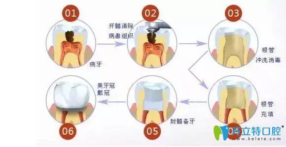 南昌輝煌口腔彭凡主任科普牙齒根管治療注意事項