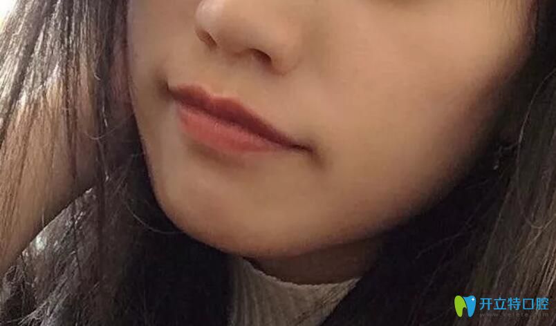 牙齒矯正過程中正面圖 牙齒矯正過程中正面圖