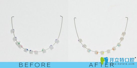 我在廣州柏德口腔戴的半隱形陶瓷牙套 我在廣州柏德口腔戴的半隱形陶瓷牙套