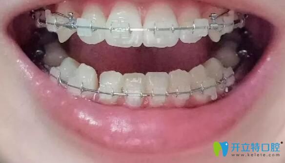 我在廣州柏德口腔戴半隱形牙套9個(gè)月 我在廣州柏德口腔戴半隱形牙套9個(gè)月