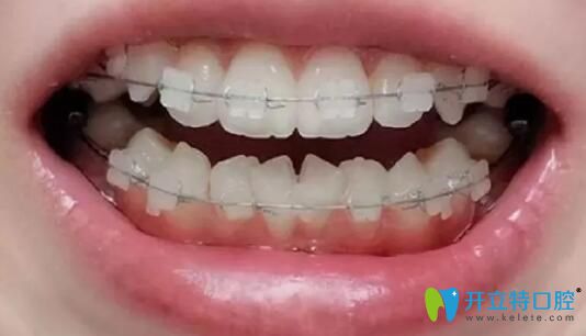 我在廣州柏德口腔做牙齒矯正第6個(gè)月 我在廣州柏德口腔做牙齒矯正第6個(gè)月