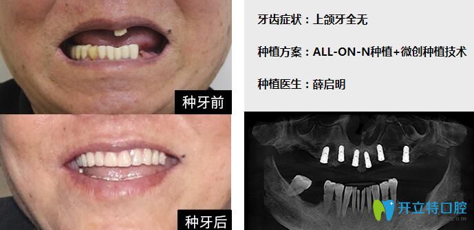 廣州柏德口腔薛啟明醫(yī)生半口種植牙案例