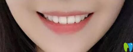 我在廣州柏德口腔做牙齒矯正1年 我在廣州柏德口腔做牙齒矯正1年