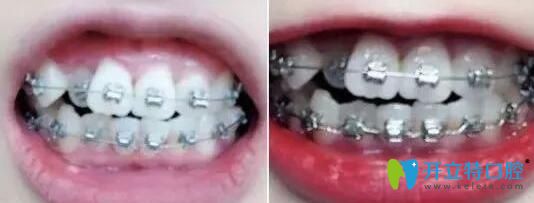 在珠海仁愛口腔做牙齒矯正第3和第4個月
