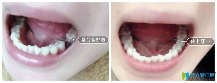 珠海仁愛(ài)口腔種植牙案例