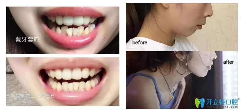 清華陽(yáng)光口腔下頜牙列擁擠矯正案例圖