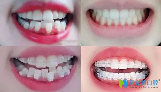<!--<i data=20240703-sp></i>-->口腔整牙案例前后效果對(duì)比圖