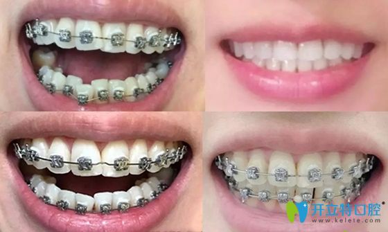 西安畫美口腔牙齒矯正案例效果圖