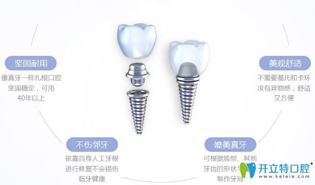 種植牙優(yōu)勢(shì)圖