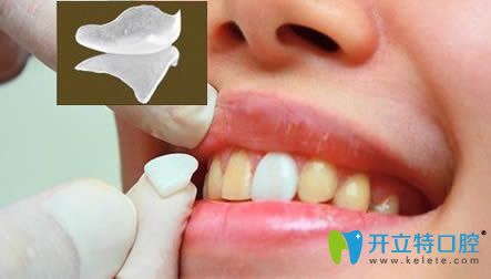 王巍科普數(shù)字化牙齒貼面的優(yōu)勢