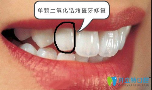 單顆二氧化鋯烤瓷牙修復效果