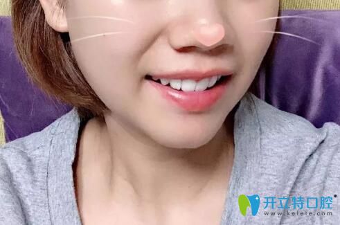 華美口腔牙齒擁擠不齊下牙套戴保持器效果圖