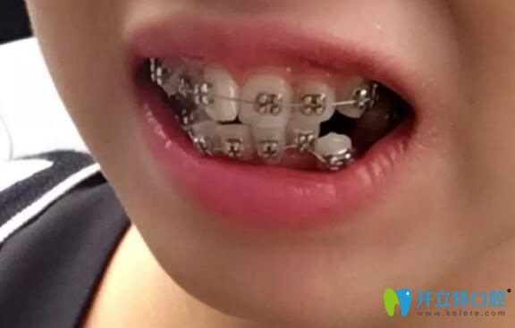 牙齒擁擠不齊戴鋼絲牙套矯正