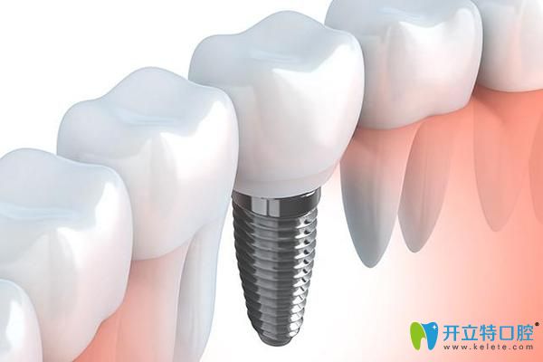 寧波恒美口腔徐路路科普種植牙術(shù)后注意事項(xiàng)