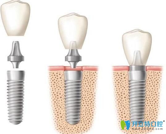 種植牙修復(fù)