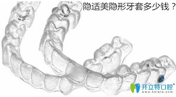 隱適美隱形牙套多少錢