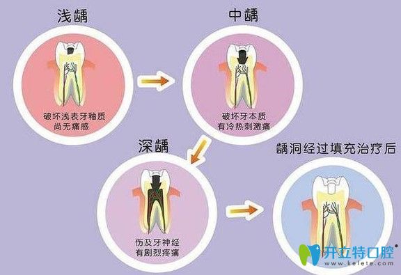 齲齒的發(fā)展過(guò)程圖示