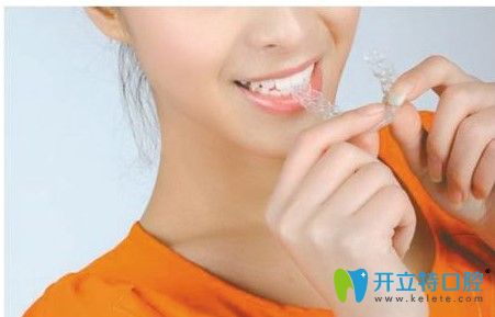 隱適美隱形牙套圖示