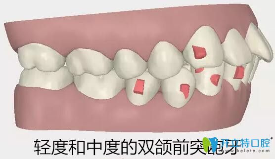 隱適美適合矯正輕度和中度的雙頜前突齙牙