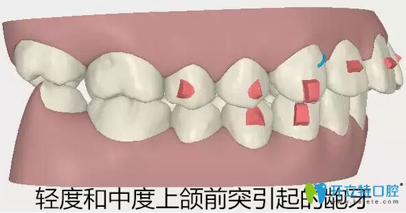 隱適美牙套適合矯正輕度和中度上頜前突的齙牙