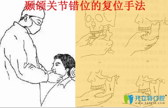 顳頜關(guān)節(jié)錯位的復位治療手法圖