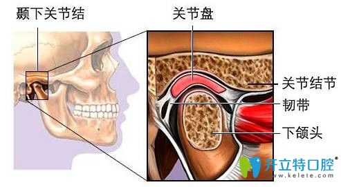 顳下頜關(guān)節(jié)紊亂能整牙嗎？正畸會(huì)不會(huì)導(dǎo)致顳頜關(guān)節(jié)紊亂？