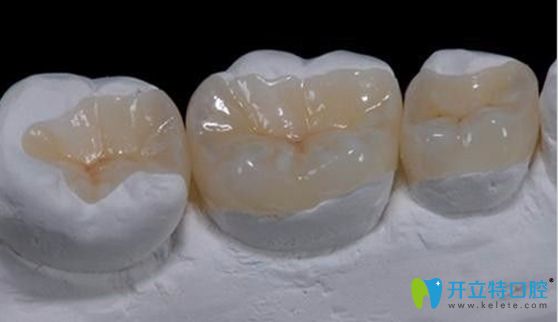 嵌體修復(fù)適合活髓牙而高嵌更適合于死髓牙修復(fù)