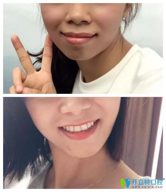 小齙牙矯正前后正面臉型對(duì)比圖