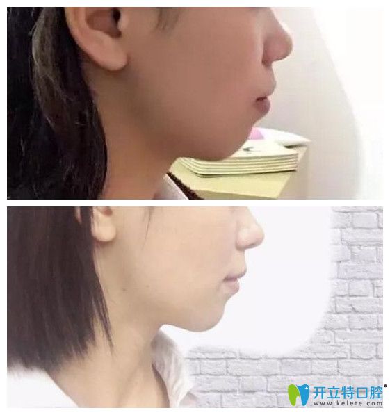 齙牙矯正前后側(cè)臉對(duì)比照片