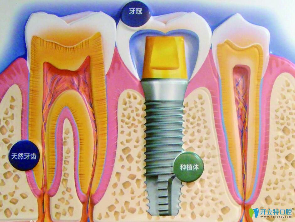 人工種植牙什么材料好?不同的材料的種植牙價(jià)格各是多少?