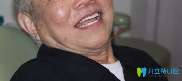 林老伯做完半口種植牙后談感受 林老伯做完半口種植牙后談感受