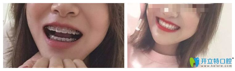 矯正后牙齒圖片
