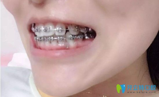 牙齒矯正9個(gè)多月圖片