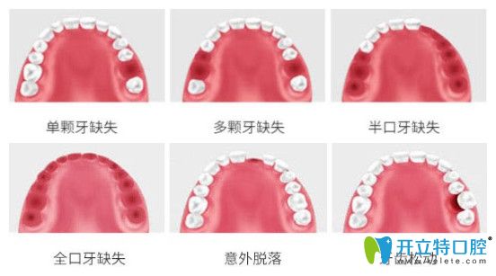 哪些牙齒缺失可以做種植牙圖示