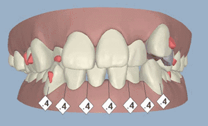 insignia精準(zhǔn)矯正牙齒移動圖