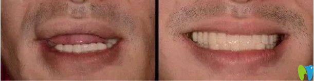 武漢德韓口腔醫(yī)生顧客種植牙前后對(duì)比圖