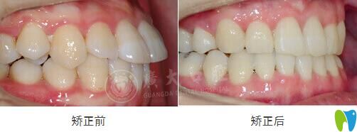 門牙前突在廣州廣大口腔做GA精準(zhǔn)數(shù)字化矯正效果