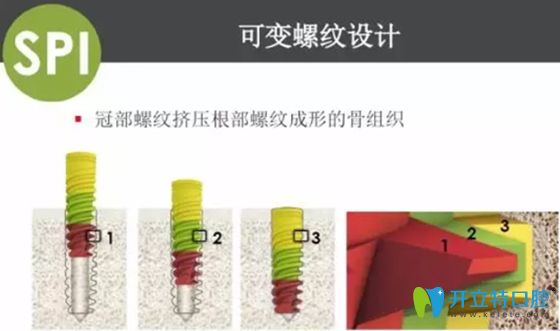 以色列abt種植體早期骨結(jié)合良好